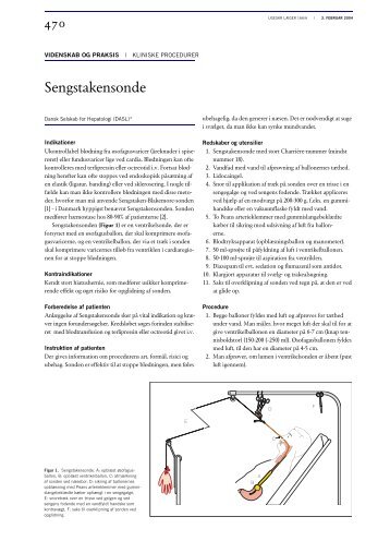 Sengstakensonde - Ugeskrift for Læger