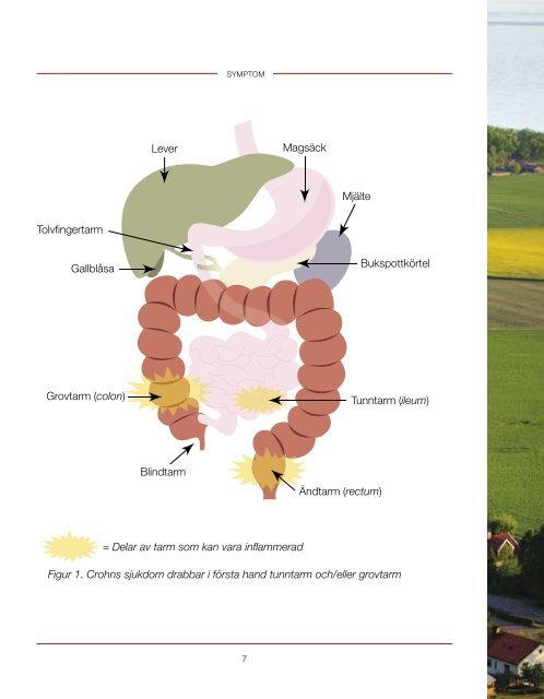 Om Crohns sjukdom… - Magakuten