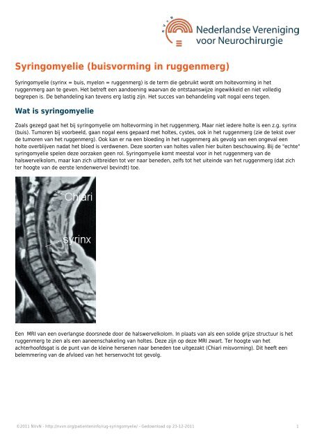 Syringomyelie (buisvorming in ruggenmerg) - NcCH