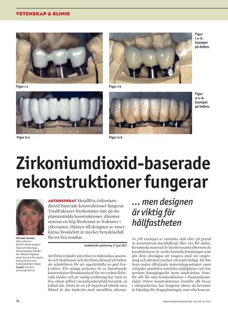 Zirkoniumdioxid-baserade rekonstruktioner fungerar