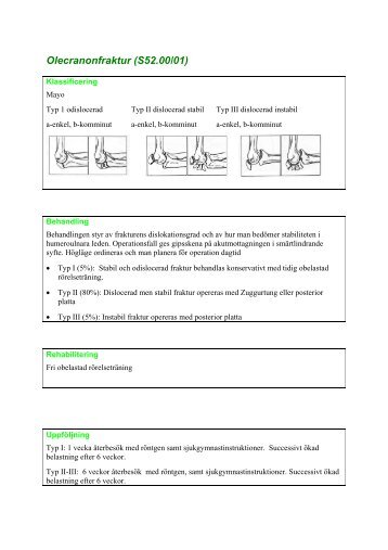 Olecranonfraktur (S52.00/01)