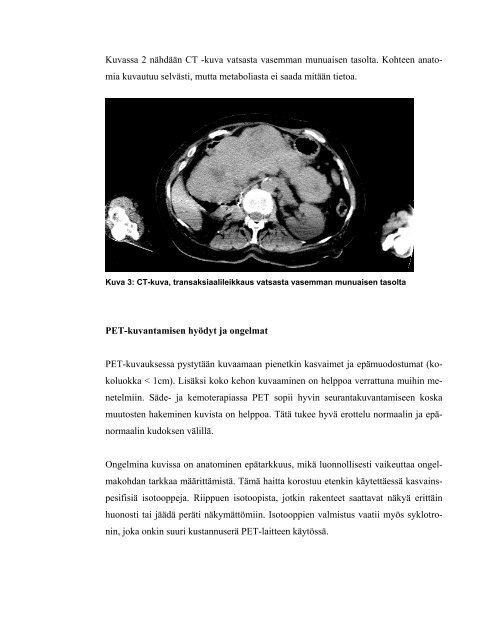 PET/CT -fuusiokuvaus