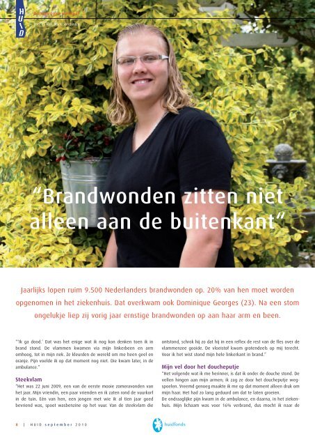 “Brandwonden zitten niet alleen aan de buitenkant“ - Huid Magazine