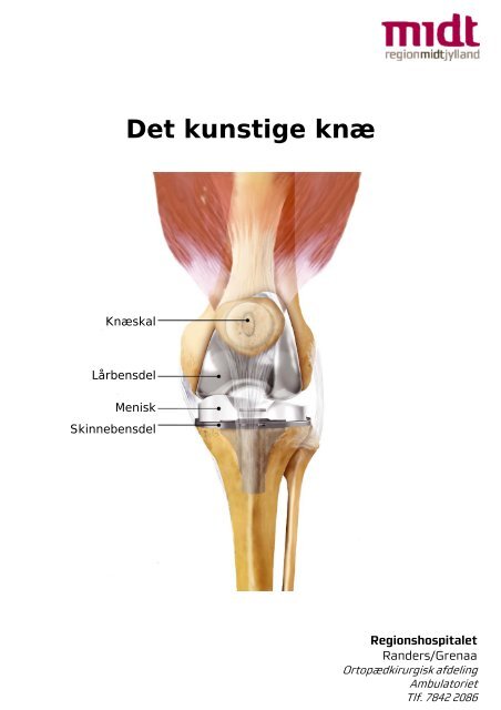 Information om Det kunstige knæ - Regionshospitalet Randers