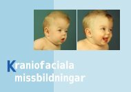 raniofaciala missbildningar - Senter for sjeldne diagnoser