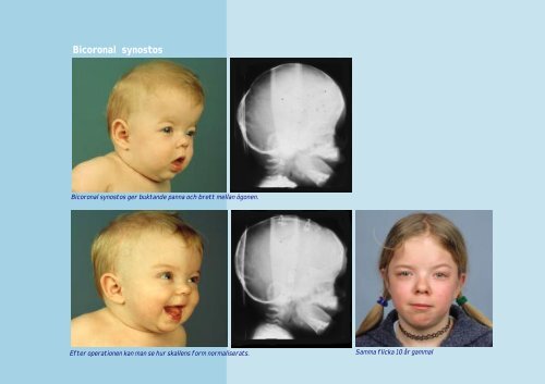 raniofaciala missbildningar - Senter for sjeldne diagnoser