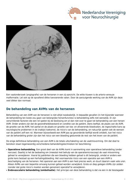 AVM (bloedvatmisvorming) - NcCH