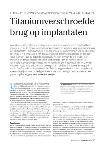 Titaniumverschroefde brug op implantaten - Implant Direct Benelux