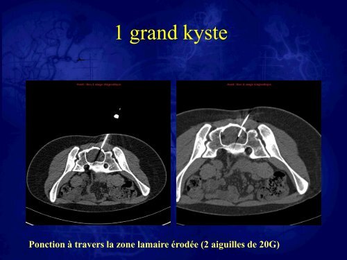 Les kystes de Tarlov. Stratégies thérapeutiques et résultats - sifud-pp