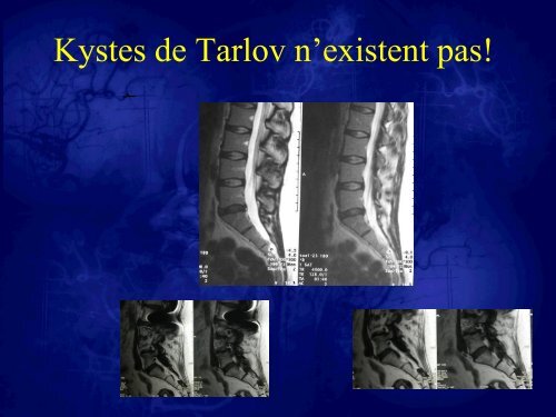 Les kystes de Tarlov. Stratégies thérapeutiques et résultats - sifud-pp