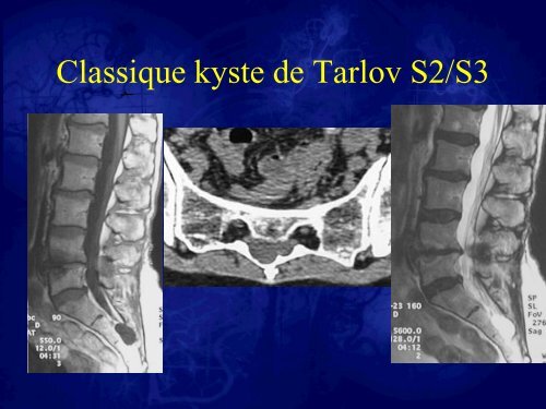 Les kystes de Tarlov. Stratégies thérapeutiques et résultats - sifud-pp