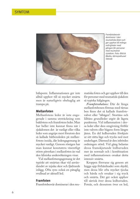 Sjukdomsbroschyr Den reumatiska foten - Reumatikerförbundet