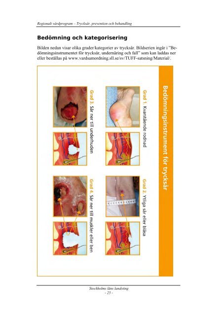 Regionalt vårdprogram: trycksår, prevention och behandling.