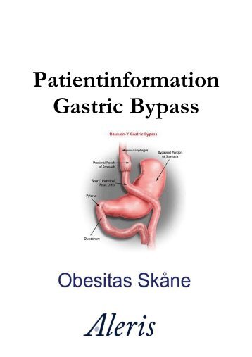 Patientinformation Gastric Bypass - Aleris