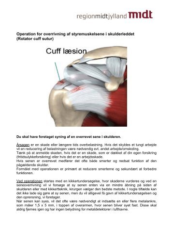 Operation for overrivning af styremuskelsene i skulderleddet - DrStorm