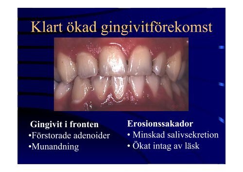 Kroniska sjukdomar hos barn- odontologiska konsekvenser