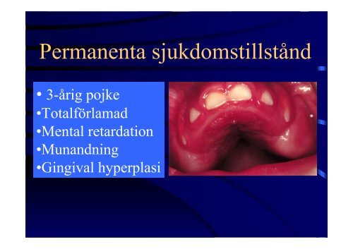 Kroniska sjukdomar hos barn- odontologiska konsekvenser