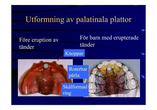 Kroniska sjukdomar hos barn- odontologiska konsekvenser