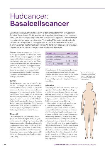 Hudcancer: Basalcellscancer - Cancerfonden