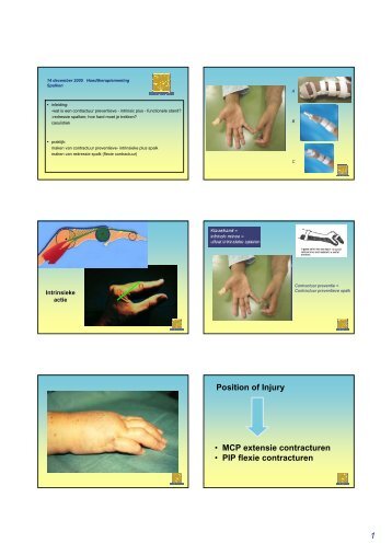 1 Position of Injury • MCP extensie contracturen • PIP flexie ...