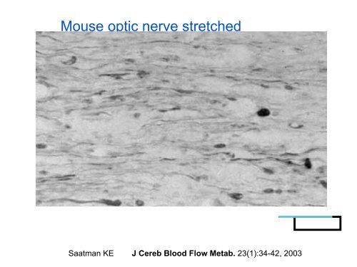 Recognition of Cranio-Cervical Instability in the Complex Chiari ...