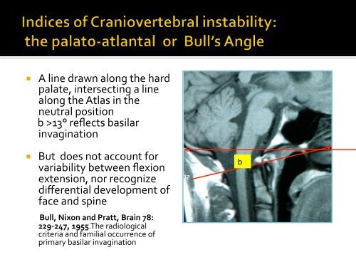 Recognition of Cranio-Cervical Instability in the Complex Chiari ...