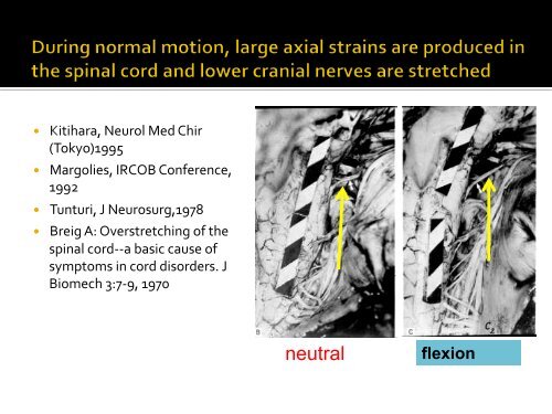 Recognition of Cranio-Cervical Instability in the Complex Chiari ...