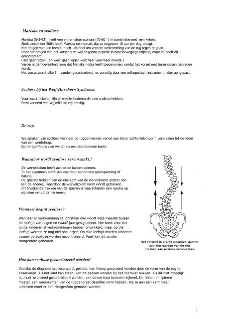 Mariska en scoliose. Scoliose bij het Wolf ... - Handicap en Zo