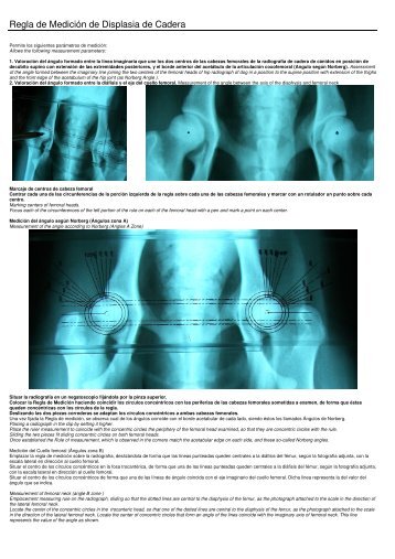 Regla de Medición de Displasia de Cadera