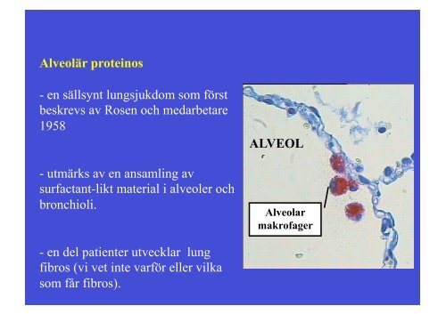 Alveolär proteinos: en fallbeskrivning Lennart Persson Lungkliniken ...