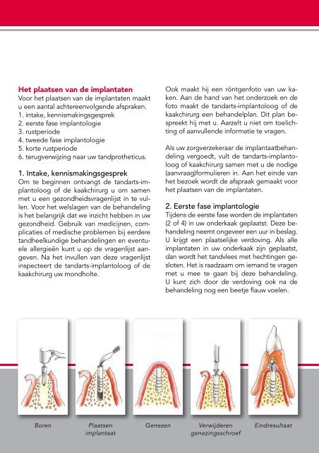 “Een kunstgebit op implantaten” (pdf) - Rutger Weijer