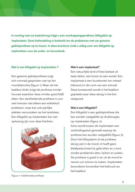 mca.nl Overkappingsprothese op implantaten