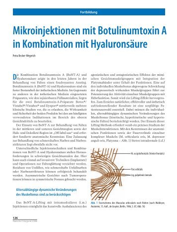 Mikroinjektionen mit Botulinumtoxin A - Laserzentrum Zürichsee
