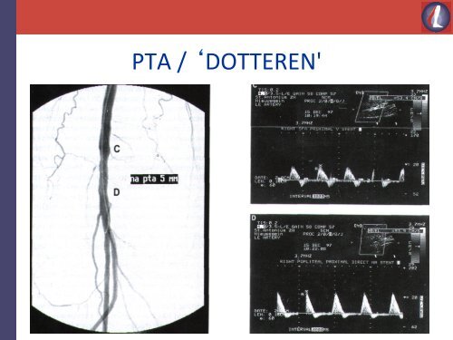 Introductie "wat is perifeer arterieel vaatlijden?" - ClaudicatioNet