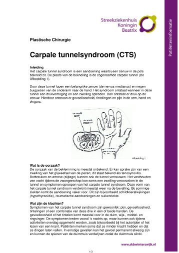 Carpale tunnelsyndroom (CTS) - Streekziekenhuis Koningin Beatrix