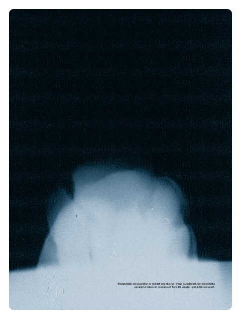 Ökad röntgentäthet i tredje karpalbenet