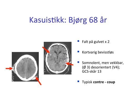 Hjernekontusjoner og diffus aksonal skade - Oslo universitetssykehus