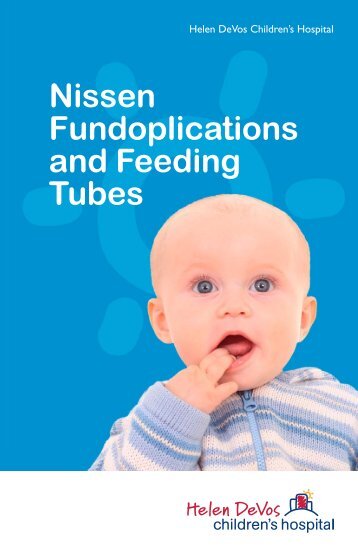 Nissen Fundoplications and Feeding Tubes - Pediatric Surgeons of ...