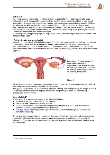 IUI; intra-uteriene inseminatie - NVOG