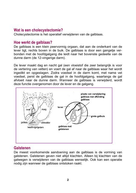 Galblaas, verwijderen van de - SJG Weert