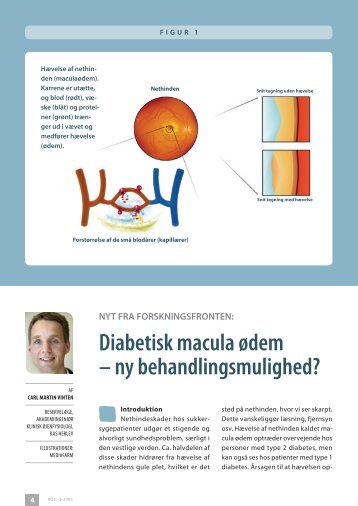 Diabetisk macula ødem – ny behandlingsmulighed? – nyt fra ...