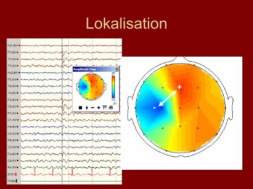 Neurofysiologi. Till vad hjälper EEG? - BLF