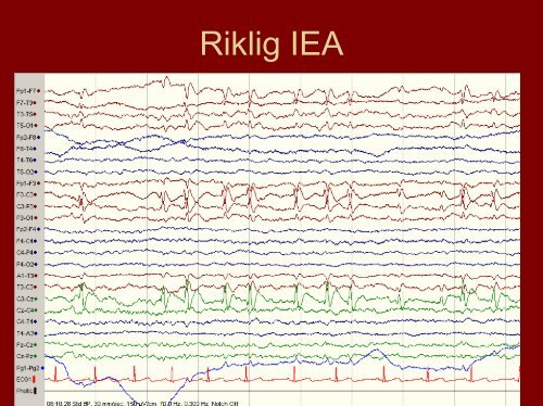 Neurofysiologi. Till vad hjälper EEG? - BLF