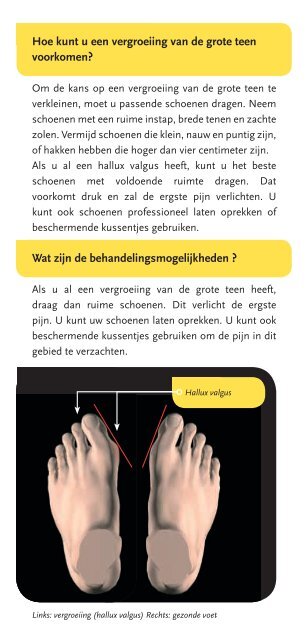 Vergroeiing van de grote teen (hallux valgus)