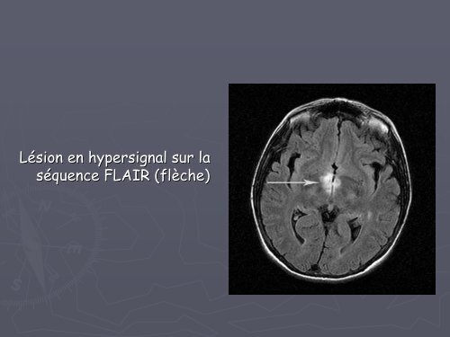 Apport de l'IRM dans le Neuro-Whipple