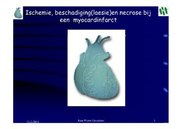 Ischemie, beschadiging(laesie)en necrose bij een ... - ECG-clopedia