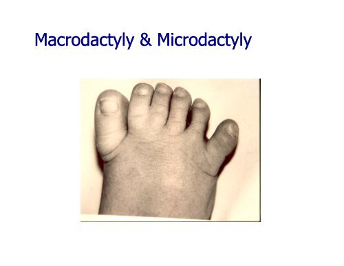 Congenital Abnormalities/Deformities of the Lower Limb