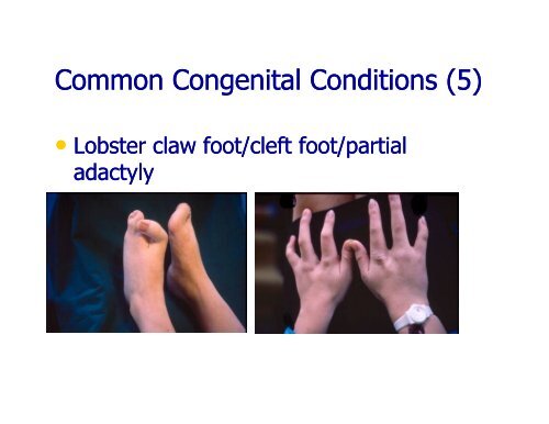 Congenital Abnormalities/Deformities of the Lower Limb