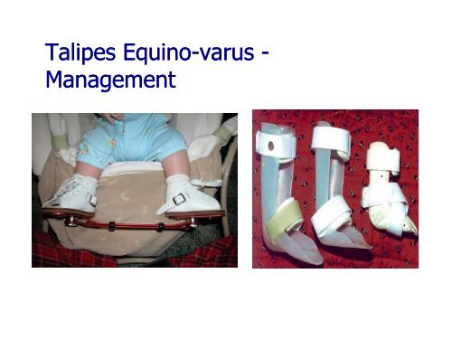 Talipes Equino Equino-var