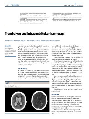 trombolyse ved intraventrikulær hæmoragi - Ugeskrift for Læger